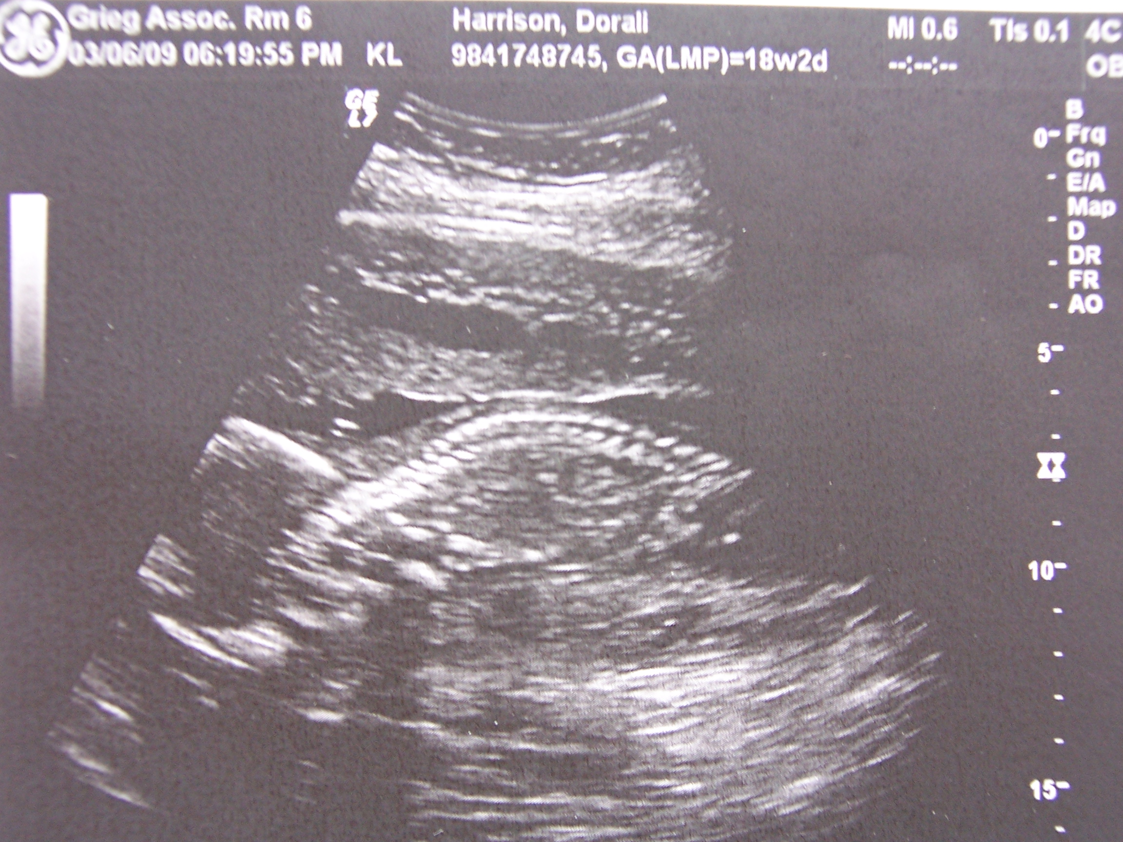 That's the baby's spine! Wiggly little guy.